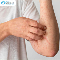 Top Skin Cancer Surgeons in India