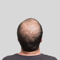 Hair transplant in Islamabad Pakistan