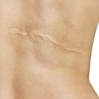 Laser Scar removal in Riyadh