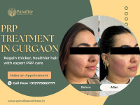 prp hair treatment in gurgaon