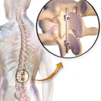 Best Spinal Fusion Surgeons of India