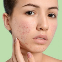 Acne scar treatment in Islamabad