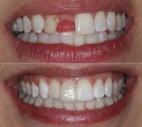 Tooth Crown Specialist Islamabad 3rd Floor, Ammar Center Jinnah Super Market, F-7 Markaz,, Islamabad, Pakistan