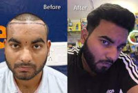 Hair transplant Doctor in Rohini