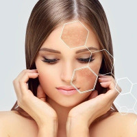 Best melasma treatment in Islamabad Pakistan