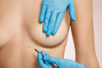 Expert Breast Reduction Surgery in Hyderabad